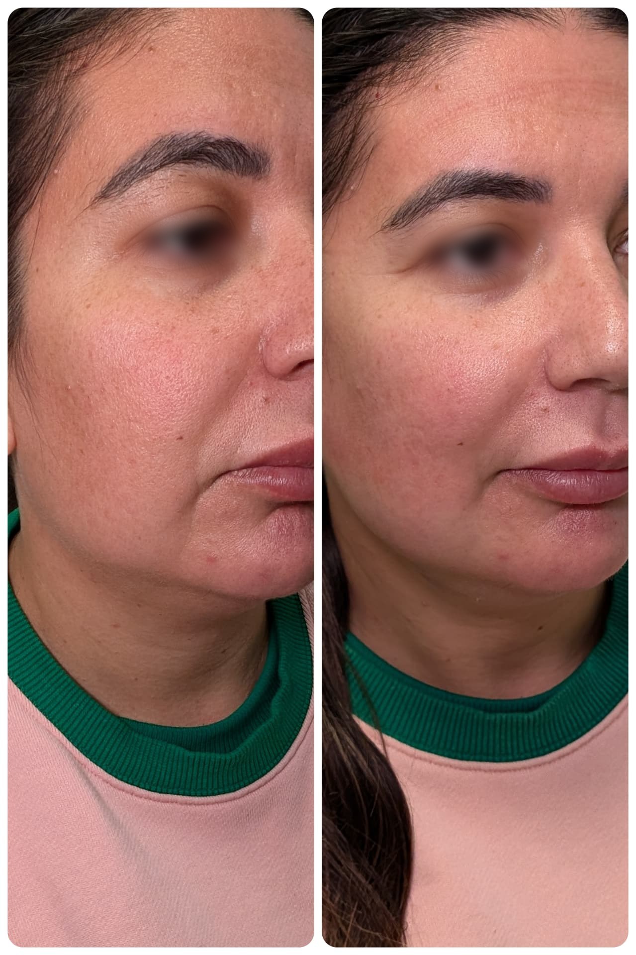 Skin rejuvenation before and after