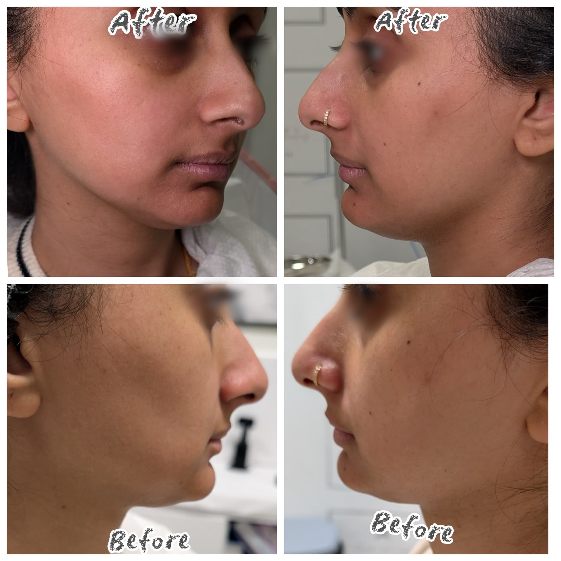 Profile balancing before and after