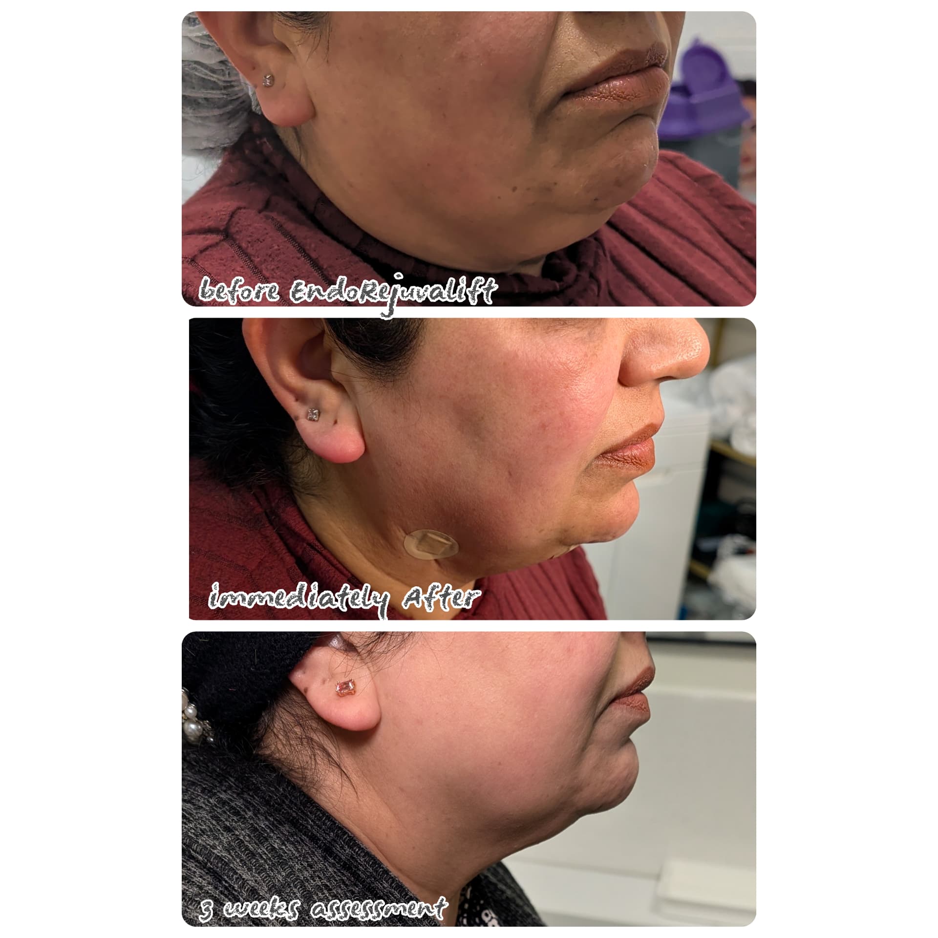 Endo-RejuvaLift · 3 weeks before and after